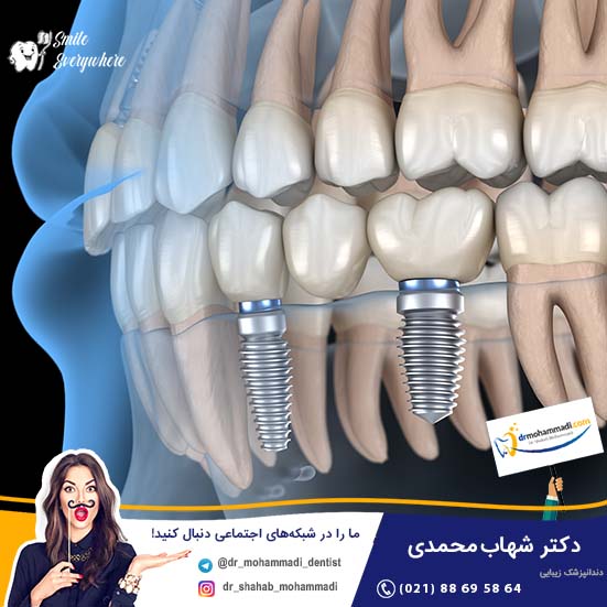 آیا ایمپلنت دندان برای فک بالا و پایین یکسان است؟ - کلینیک دندانپزشکی دکتر شهاب محمدی
